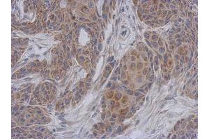 IHC-P Image Immunohistochemical analysis of paraffin-embedded Cal27 xenograft, using NDUFA12, antibody at 1:500 dilution. (NDUFA12 antibody  (full length))