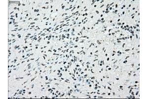 Immunohistochemical staining of paraffin-embedded Adenocarcinoma of breast tissue using anti-BRAF mouse monoclonal antibody. (BRAF antibody)