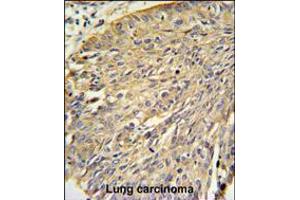 Annexin A1 Antibody IHC analysis in formalin fixed and paraffin embedded human lung carcinoma followed by peroxidase conjugation of the secondary antibody and DAB staining. (Annexin a1 antibody  (AA 129-158))