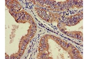 Immunohistochemistry of paraffin-embedded human endometrial cancer using ABIN7142516 at dilution of 1:100 (RPS21 antibody  (AA 1-81))