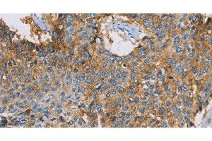 Immunohistochemistry of paraffin-embedded Human lung cancer using CDCP1 Polyclonal Antibody at dilution of 1:50 (CDCP1 antibody)