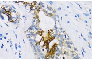 Immunohistochemistry of paraffin-embedded Human breast using PTCH1 Polyclonal Antibody at dilution of 1:100 (40x lens). (Patched 1 antibody)