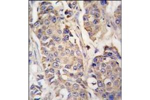 Formalin-fixed and paraffin-embedded human breast carcinoma tissue reacted with ACO2 antibody (Center), which was peroxidase-conjugated to the secondary antibody, followed by DAB staining. (ACO2 antibody  (Middle Region))