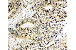 IHC-P: NME2 antibody testing of human intestinal cancer tissue (NME2 antibody  (AA 137-152))
