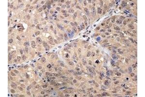 Immunohistochemical staining of formalin-fixed paraffin-embedded urinary bladder cancer showing nuclear staining with anti-HOPX antibody at a dilution of 1/100. (HOPX antibody)
