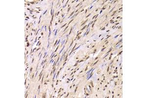 Immunohistochemistry of paraffin-embedded human adenomyosis using SNRPA Antibody (ABIN5973811) at dilution of 1/100 (40x lens). (SNRPA1 antibody)