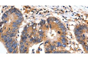 Immunohistochemistry of paraffin-embedded Human colon cancer using FADD Polyclonal Antibody at dilution of 1:35 (FADD antibody)
