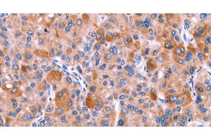 Immunohistochemistry of paraffin-embedded Human liver cancer tissue using GCG Polyclonal Antibody at dilution 1:40 (Glucagon antibody)