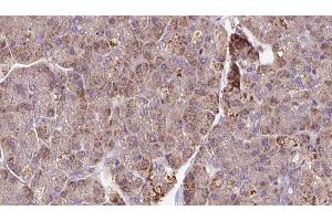 ABIN6273289 at 1/100 staining Human pancreas cancer tissue by IHC-P. (PCMT1 antibody  (Internal Region))