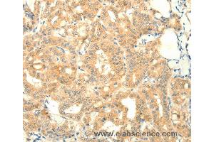 Immunohistochemistry of Human thyroid cancer using SNAP25 Polyclonal Antibody at dilution of 1:25 (SNAP25 antibody)