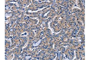 The image on the left is immunohistochemistry of paraffin-embedded Human thyroid cancer tissue using ABIN7191592(NCR2 Antibody) at dilution 1/60, on the right is treated with synthetic peptide. (NKp44/NCR2 antibody)