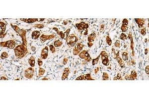 Immunohistochemistry of paraffin-embedded Human liver cancer tissue using SAA1 Polyclonal Antibody at dilution of 1:70(x200) (SAA1 antibody)