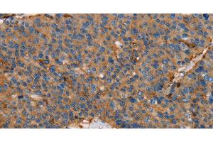 Immunohistochemistry of paraffin-embedded Human liver cancer using ACTA1 Polyclonal Antibody at dilution of 1:65 (Actin antibody)