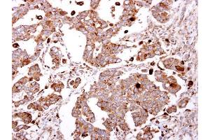 IHC-P Image beta-Gal antibody [N2C3] detects beta-Gal protein at cytosol on human ovarian carcinoma by immunohistochemical analysis. (GLB1 antibody)