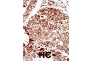 Formalin-fixed and paraffin-embedded human cancer tissue reacted with the primary antibody, which was peroxidase-conjugated to the secondary antibody, followed by DAB staining. (PEBP1 antibody  (AA 137-167))