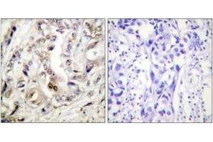 Immunohistochemistry analysis of paraffin-embedded human breast carcinoma tissue, using Progesterone Receptor (Ab-400) Antibody. (Progesterone Receptor antibody  (AA 371-420))