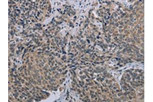 The image on the left is immunohistochemistry of paraffin-embedded Human cervical cancer tissue using ABIN7191408(MARVELD1 Antibody) at dilution 1/40, on the right is treated with synthetic peptide. (MARVELD1 antibody)