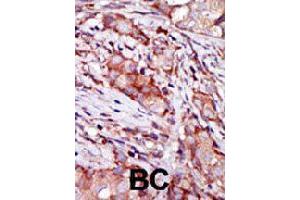 Formalin-fixed and paraffin-embedded human breast cancer tissue reacted with CIB2 polyclonal antibody  , which was peroxidase-conjugated to the secondary antibody, followed by AEC staining. (CIB2 antibody  (N-Term))