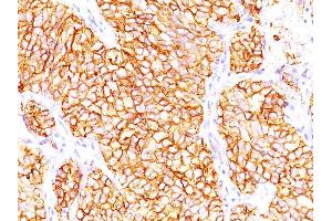 Formalin-fixed, paraffin-embedded human Renal Cell Carcinoma stained with RCC Mouse Monoclonal Antibody (66.