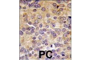 Formalin-fixed and paraffin-embedded human prostata carcinoma tissue reacted with PRMT3 antibody (N-term), which was peroxidase-conjugated to the secondary antibody, followed by DAB staining. (PRMT3 antibody  (N-Term))