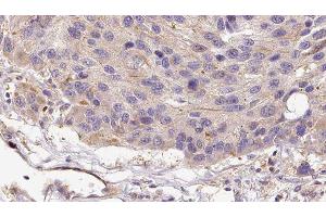 ABIN6279108 at 1/100 staining Human melanoma tissue by IHC-P. (alpha 2 Antiplasmin antibody  (C-Term))
