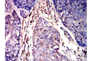 Immunohistochemical analysis of paraffin-embedded esophageal cancer tissues using GSN mouse mAb with DAB staining.