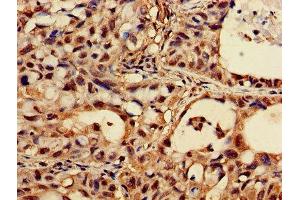 Immunohistochemistry of paraffin-embedded human lung cancer using ABIN7162924 at dilution of 1:100 (CASK antibody  (AA 470-760))