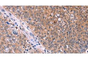 Immunohistochemistry of paraffin-embedded Human ovarian cancer tissue using EDN1 Polyclonal Antibody at dilution 1:50 (Endothelin 1 antibody)