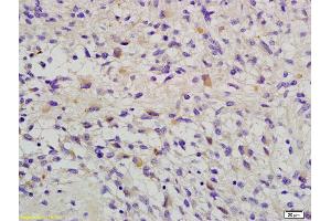 Formalin-fixed and paraffin embedded human glioma labeled with Anti-RAB-14 Polyclonal Antibody, Unconjugated (ABIN681898) at 1:200 followed by conjugation to the secondary antibody and DAB staining (RAB14 antibody  (AA 21-120))
