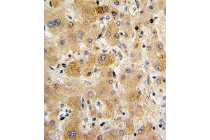 Formalin-fixed and paraffin-embedded human hepatocarcinoma with TTR Antibody (Center), which was peroxidase-conjugated to the secondary antibody, followed by DAB staining. (TTR antibody  (AA 47-74))