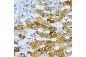 Immunohistochemical analysis of IMPA1 staining in human liver cancer formalin fixed paraffin embedded tissue section. (IMPA1 antibody)