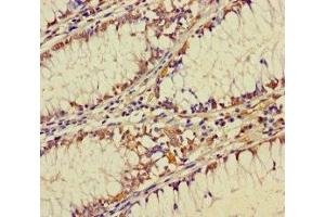Immunohistochemistry of paraffin-embedded human colon cancer using ABIN7176193 at dilution of 1:100 (ZNF26 antibody  (AA 1-200))