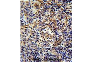 CASKIN2 antibody(Center) immunohistochemistry analysis in formalin fixed and paraffin embedded human lung carcinoma followed by peroxidase conjugation of the secondary antibody and DAB staining. (CASKIN2 antibody  (Middle Region))