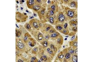 Immunohistochemical analysis of c-RAF staining in human liver cancer formalin fixed paraffin embedded tissue section. (RAF1 antibody  (C-Term))