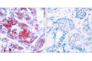 Immunohistochemistry analysis of paraffin-embedded human breast carcinoma, using STAT4 (Phospho-Tyr693) Antibody.