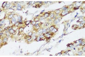 Immunohistochemistry of paraffin-embedded Human liver cancer using ECI2 Polyclonal Antibody at dilution of 1:150 (40x lens). (PECI/ECI2 antibody)