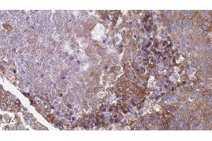 ABIN6276868 at 1/100 staining Human urothelial cancer tissue by IHC-P. (IFNAR2 antibody)