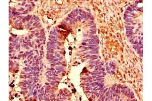 Immunohistochemistry of paraffin-embedded human ovarian cancer using ABIN7150430 at dilution of 1:100 (POLR2C antibody  (AA 2-275))