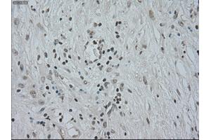 Immunohistochemical staining of paraffin-embedded Carcinoma of kidney tissue using anti-CTAG1Bmouse monoclonal antibody. (CTAG1B antibody)