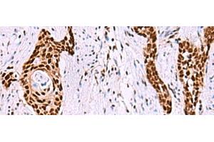 Immunohistochemistry of paraffin-embedded Human esophagus cancer tissue using ISY1-RAB43 Polyclonal Antibody at dilution of 1:55(x200) (ISY1-RAB43 Readthrough (ISY1-RAB43) antibody)