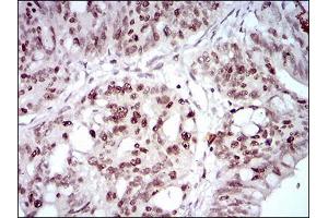 Immunohistochemical analysis of paraffin-embedded rectum cancer tissues using HOXB4 mouse mAb with DAB staining.