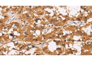 Immunohistochemistry of paraffin-embedded Human thyroid cancer tissue using CD22 Polyclonal Antibody at dilution 1:50 (CD22 antibody)