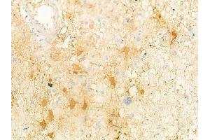 ABIN6261917 and ABIN6278468 at 1/100 staining human astrocytoma by IHC-P. (GUCY1A1 antibody  (C-Term))