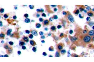 Detection of CTLA4 in Human Tonsil Tissue using Polyclonal Antibody to Cytotoxic T-Lymphocyte Associated Antigen 4 (CTLA4) (CTLA4 antibody  (AA 52-211))