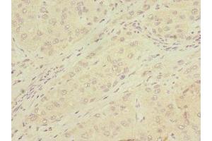 Immunohistochemistry of paraffin-embedded human liver cancer using ABIN7159068 at dilution of 1:100 (MMP19 antibody  (AA 209-508))