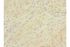 Immunohistochemistry of paraffin-embedded human liver cancer using ABIN7159068 at dilution of 1:100 (MMP19 antibody  (AA 209-508))