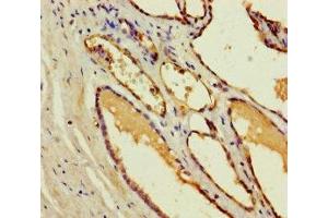 Immunohistochemistry of paraffin-embedded human prostate cancer using ABIN7148974 at dilution of 1:100 (CST11 antibody  (AA 1-138))