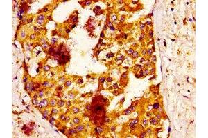 IHC image of ABIN7157026 diluted at 1:100 and staining in paraffin-embedded human breast cancer performed on a Leica BondTM system. (IQCB1 antibody  (AA 445-598))