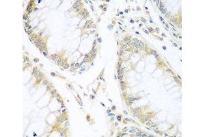 Immunohistochemistry of paraffin-embedded Human gastric cancer using CUL3 Polyclonal Antibody at dilution of 1:100 (40x lens). (Cullin 3 antibody)