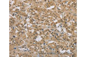 Immunohistochemistry of Human breast cancer using PKD1 Polyclonal Antibody at dilution of 1:50